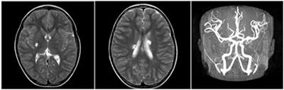 Where the cerebral infarction meets child, be vigilant about patent foramen ovale: a case report